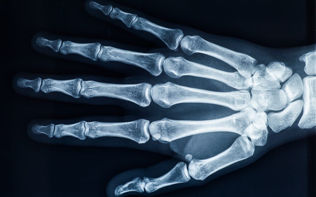 How Do I Know If I Need an X-ray?